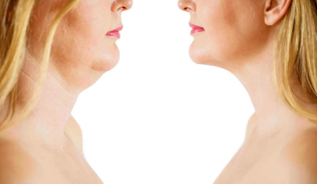 Double Chin treatment Liverpool before and after results