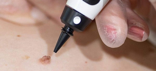 After Skin Tag Removal Liverpool
