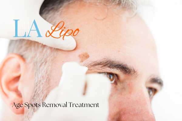What Are the Most Effective Treatments for Age Spots Liverpool?