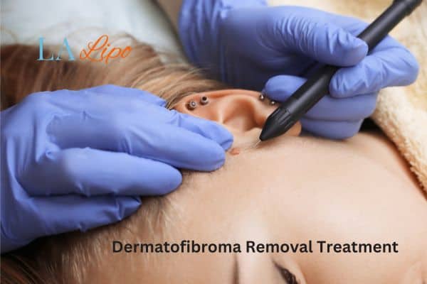 Dermatofibroma Removal Treatment Liverpool