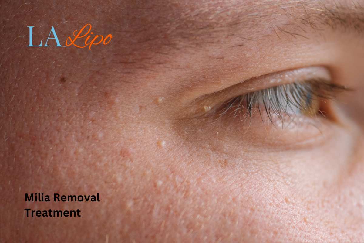 Cryopen Milia Removal: Is It the Easiest and Safest Option Liverpool?