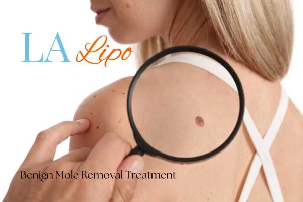 Why getting moles removed Liverpool can boost your confidence!