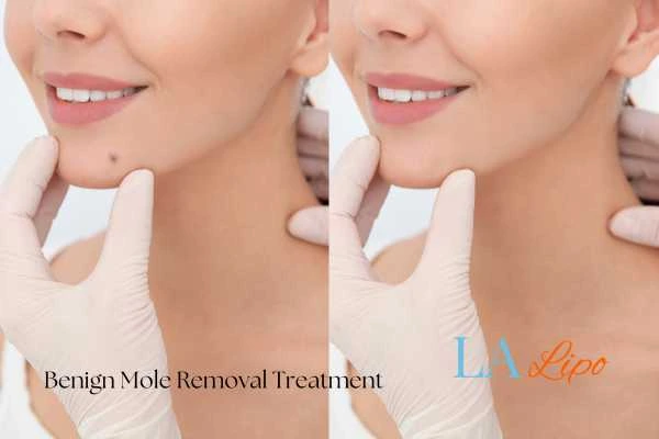 Woman's before and after results of being moles removal treatment Liverpool
