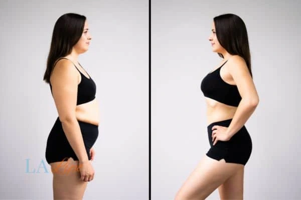 image of woman before and after results of LA-EMS Body Sculpting Liverpool to help treat Diastasis recti
