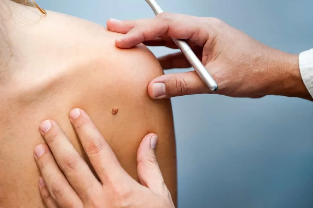 Assessing a blemish before Solar Lentigo Removal Liverpool
