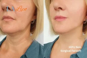 hi-fu for wrinkles Liverpool before and after results