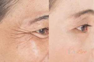 Before and after results of woman - HI-fu wrinkles reduction treatment Liverpool