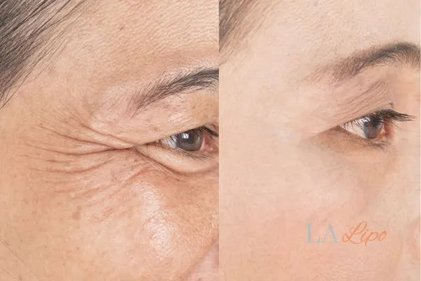 Before and after results of woman - HI-fu wrinkles reduction treatment Liverpool