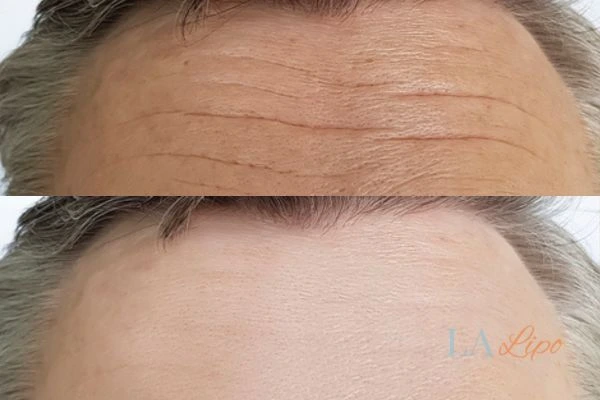 results of HIFU Liverpool on mans forehead to help reduce lines and wrinkles