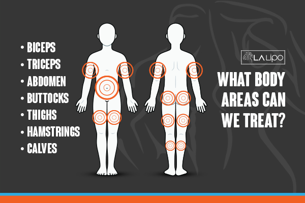 Graphic to show areas you can have LA-EMS Body Sculpting Liverpool treatment.