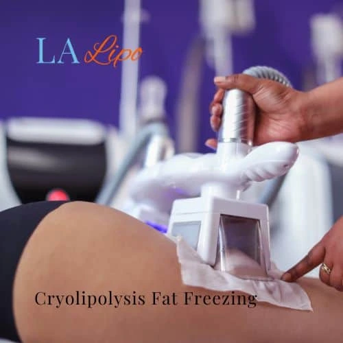 fat freezing - Cryolipolysis Liverpool