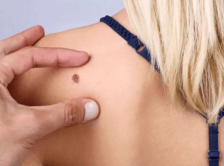 woman having mole removal Liverpool consultation before treatment.