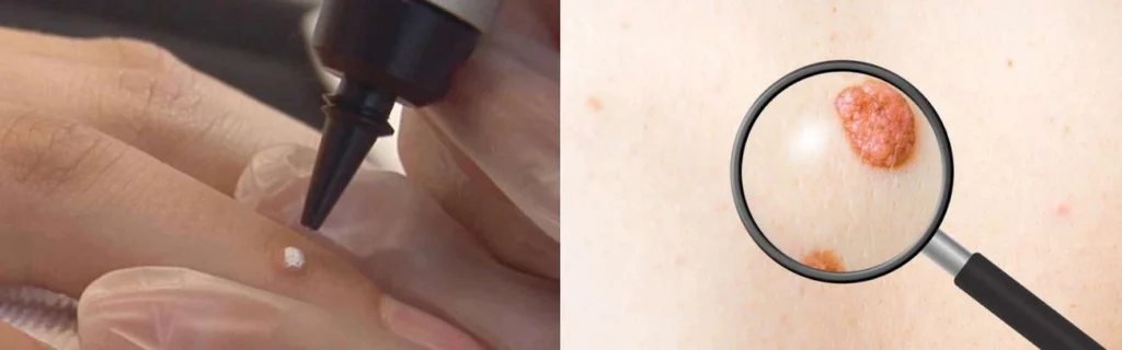 Person getting moles removed with cryopen Liverpool