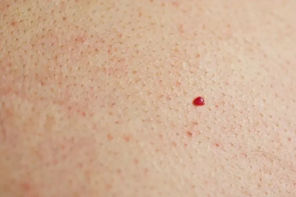 close up of a cherry angioma Liverpool