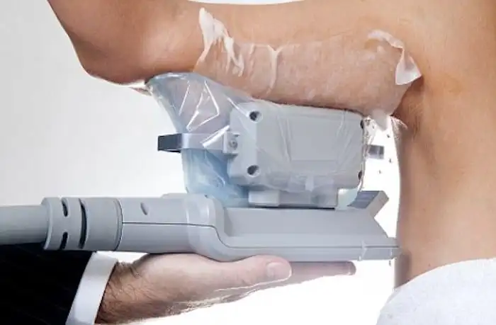 Picture of fat freezing Liverpool on the upper arms.