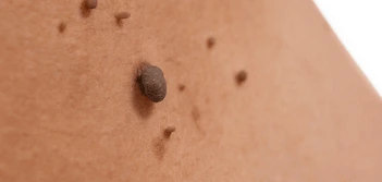 image of a skin tag Liverpool