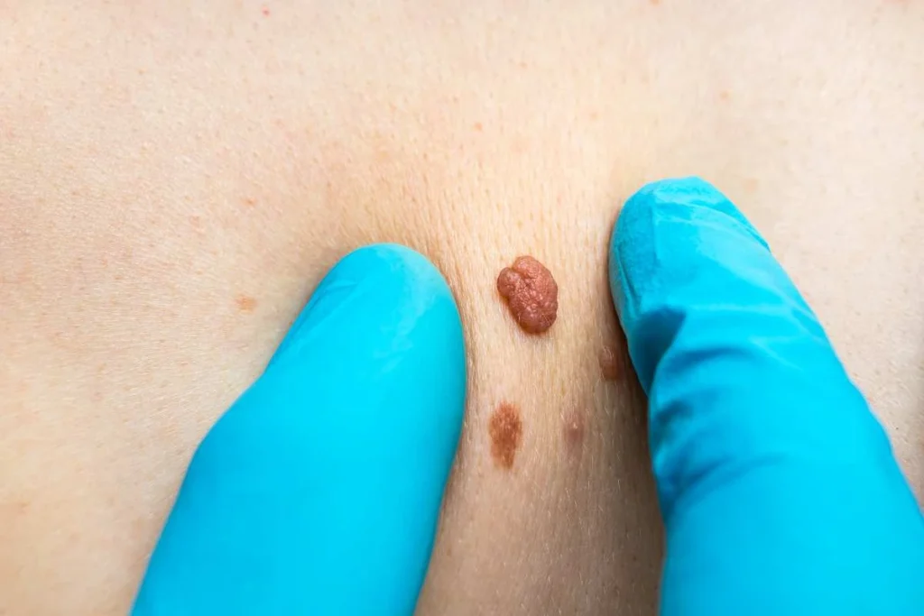 Consultant examining a skin tag Liverpool