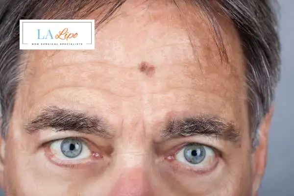 Solar Lentigo Removal Liverpool image of man with mark on his forehead