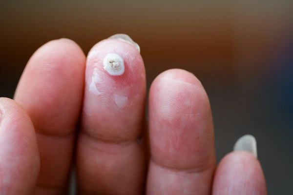 wart on person finger - cryotherapy to treat from LA LIPO Liverpool