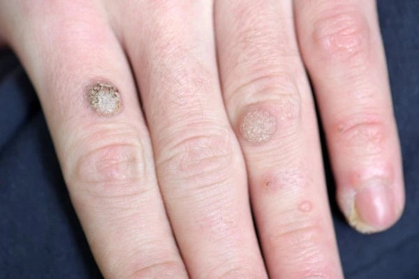 photo of warts on person hand - see wart removal Liverpool from LA LIPO