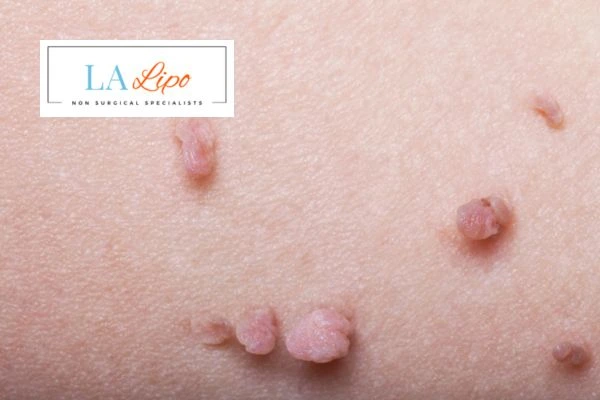 Does cryopen skin tag removal Liverpool hurt? Find out now call our team today!