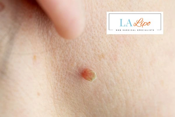 Book skin tag removal Liverpool today speak to our team now!