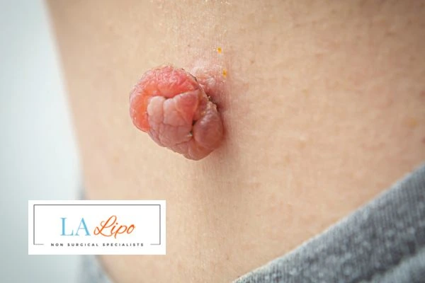 Interested in skin tag removal Liverpool? Concerned about the pain? Find out more today!