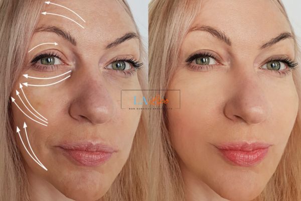 Morpheus 8 results Liverpool face lift.