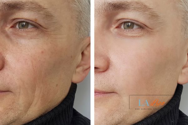 See the amazing results of Morpheus8 Treatment Liverpool!