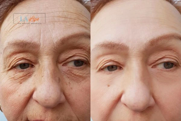 The powerful benefits of Morpheus8 Treatment Liverpool - Call Our team today!