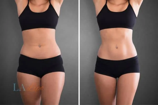 before and after results of non-surgical treatment to help a woman's body image and mental health Liverpool