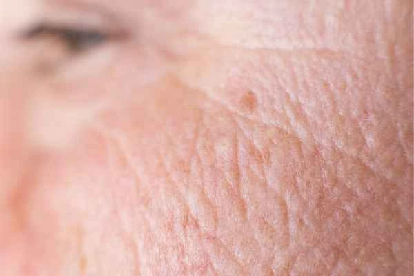 close up picture of a woman's face showing an age spot Liverpool