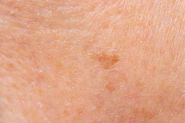 close up picture of age spots Liverpool