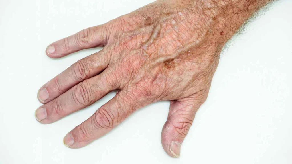Male hand showing age spot Liverpool