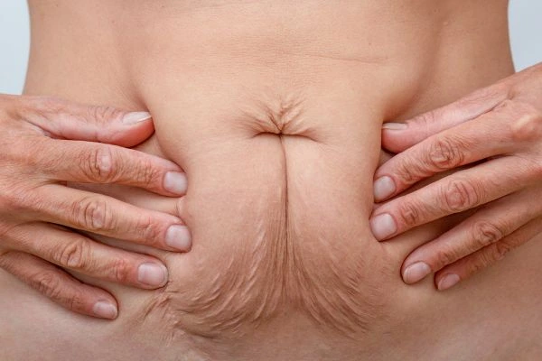Image of a woman's stomach with loose skin - example of skin tightening Liverpool options