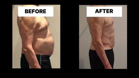 What Symptoms Can Diastasis Recti Cause in Men? Weak Core, Back Pain and Poor Posture Liverpool